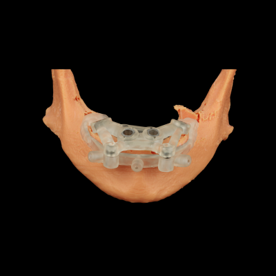 MÁNG PHẪU THUẬT 